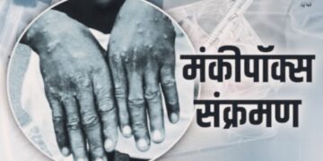 Monkeypox: दुनिया मंकीपॉक्स से सहमी, चीन ने बनाया संक्रमण से फायदा कमाने का प्लान