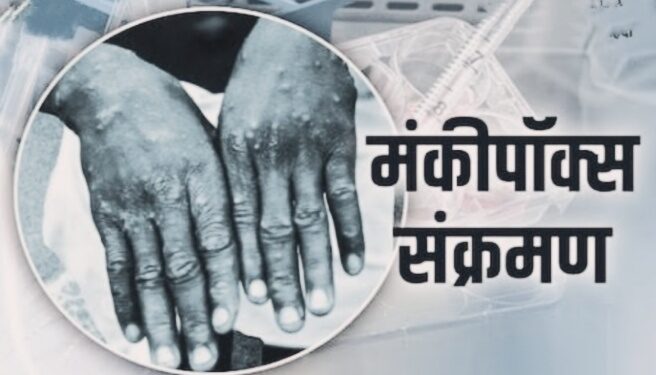 Monkeypox: दुनिया मंकीपॉक्स से सहमी, चीन ने बनाया संक्रमण से फायदा कमाने का प्लान