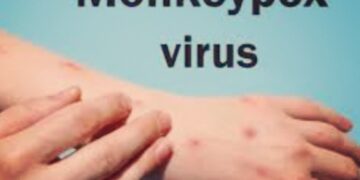 monkeypox